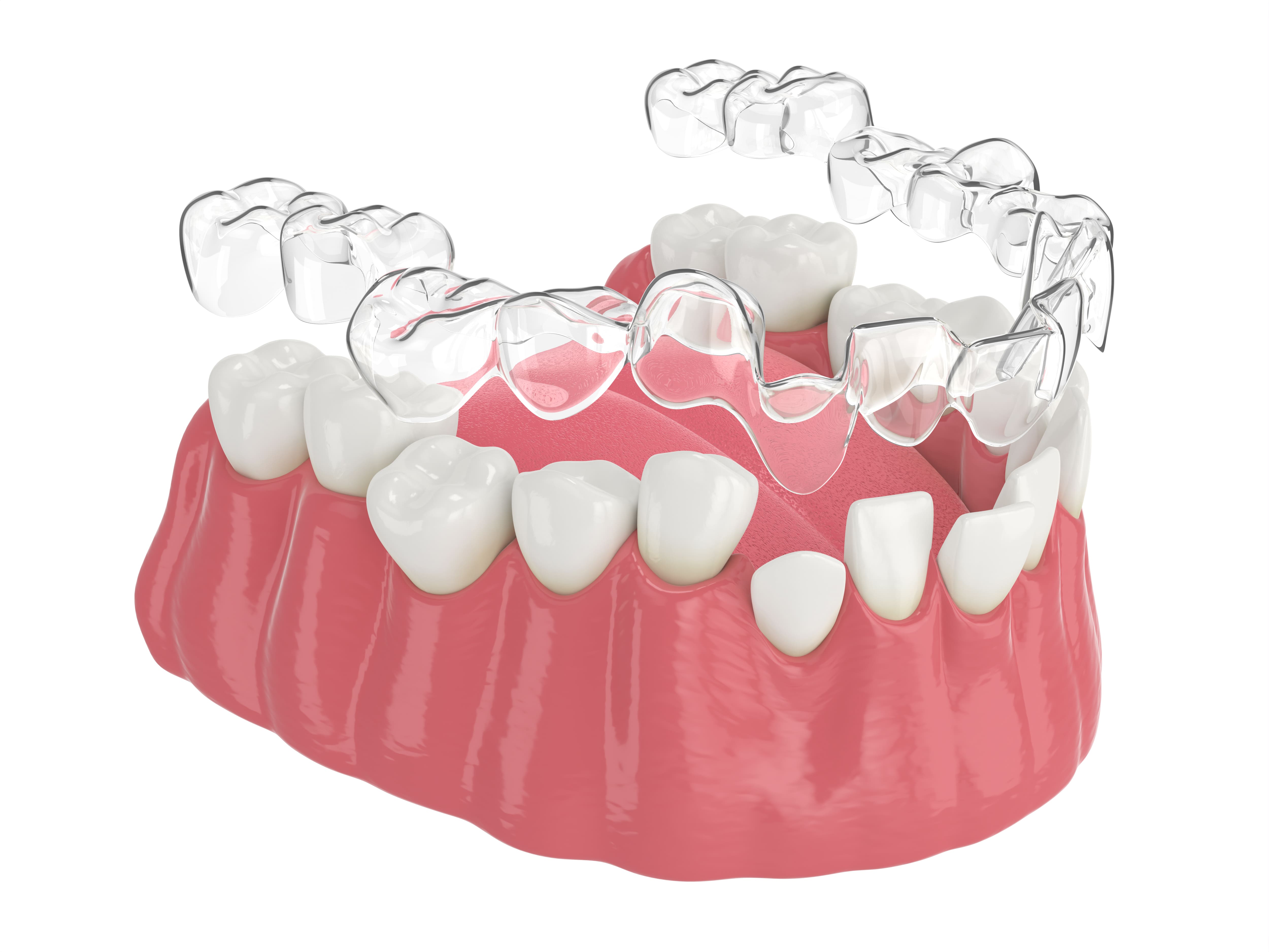 clear dental aligners