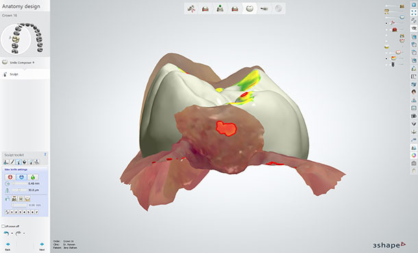 Design your mesial and distal contacts